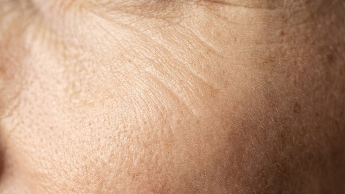 Aging Skin