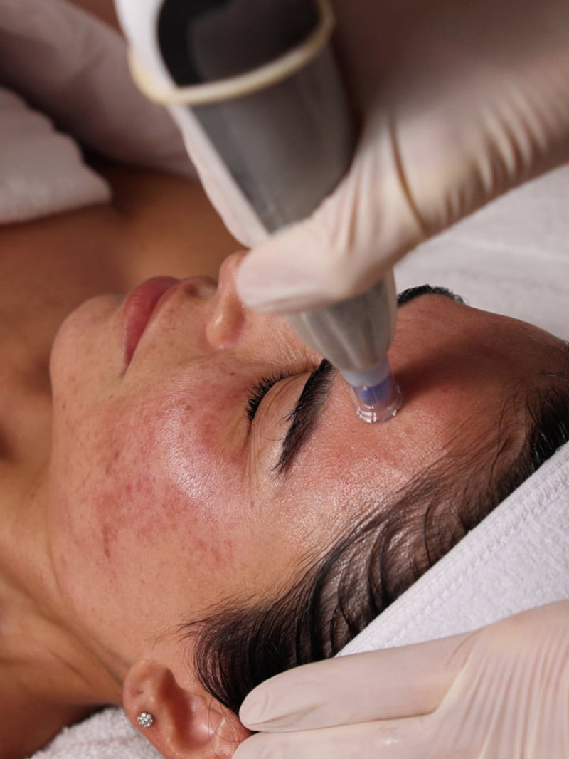 Microneedling
