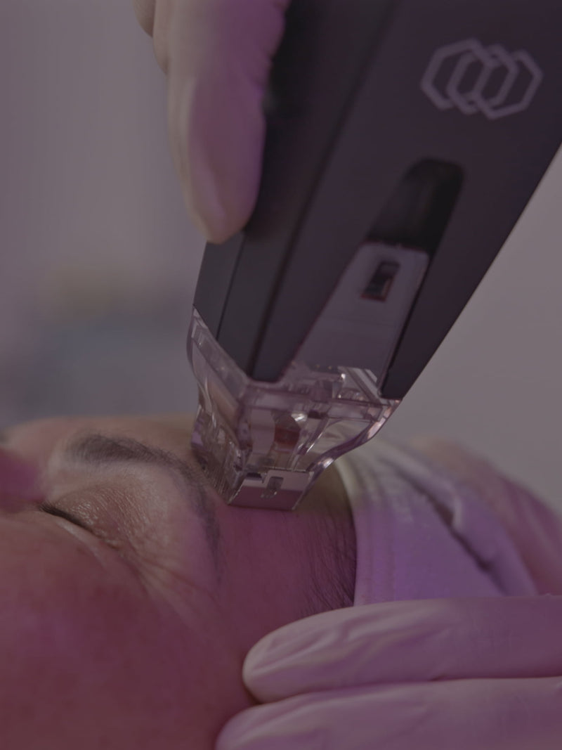 Microneedling & RF