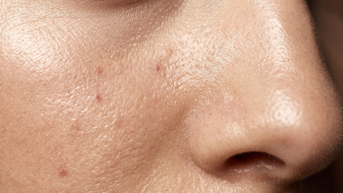 Acne or Oily
