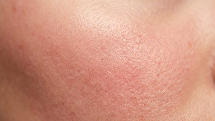 Redness or Sensitive