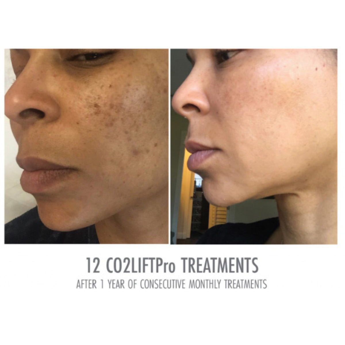 Lumisque CO2Lift PRO Mask lifestyle image