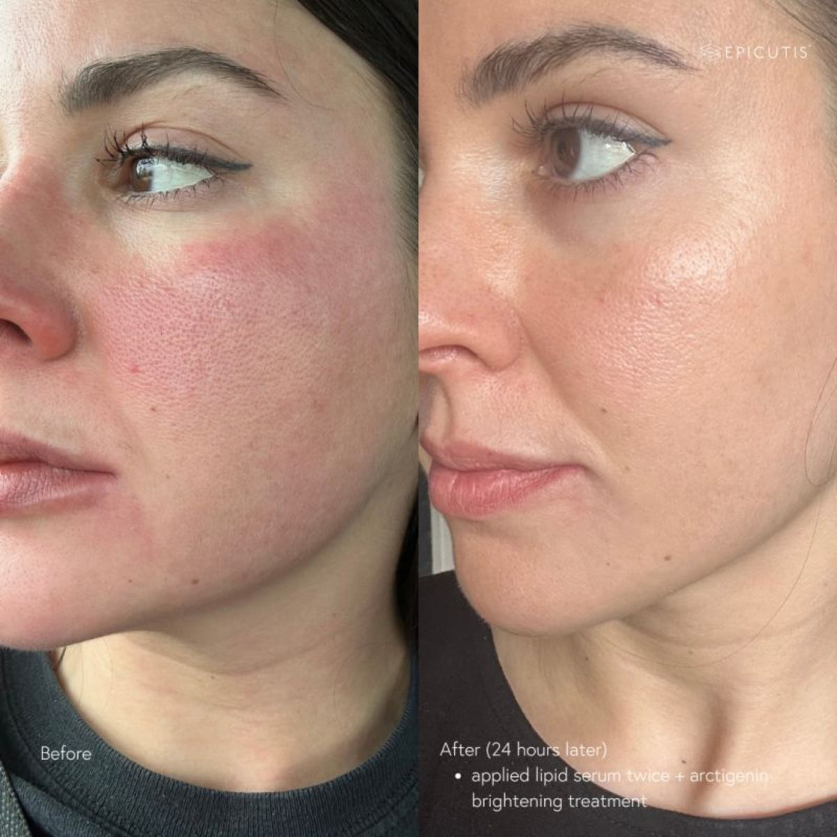Epicutis Lipid Serum lifestyle image