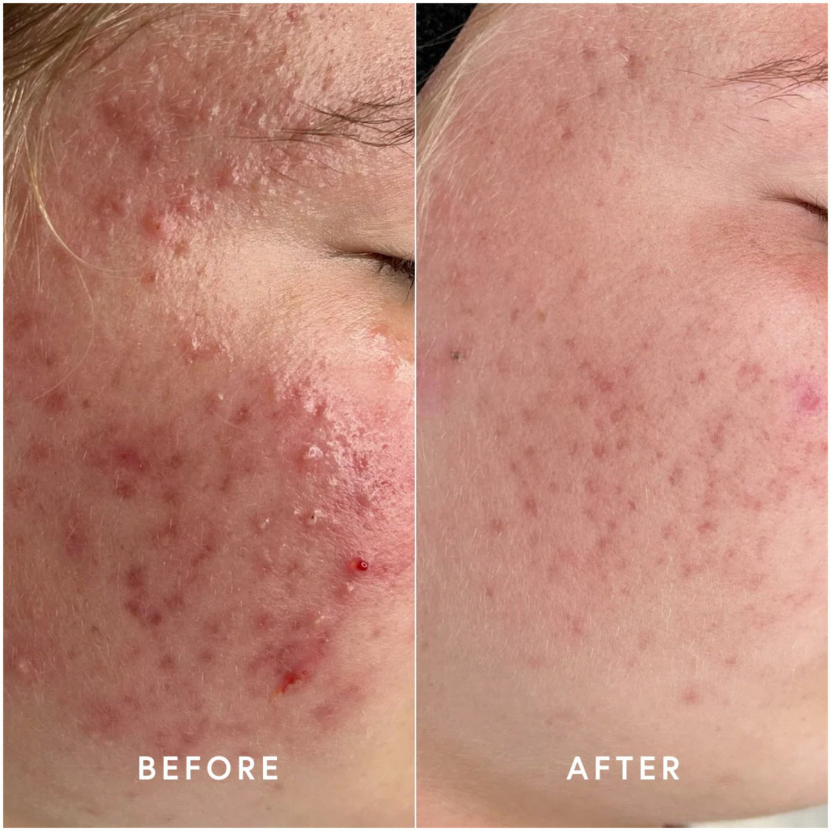 Epicutis Lipid Serum lifestyle image