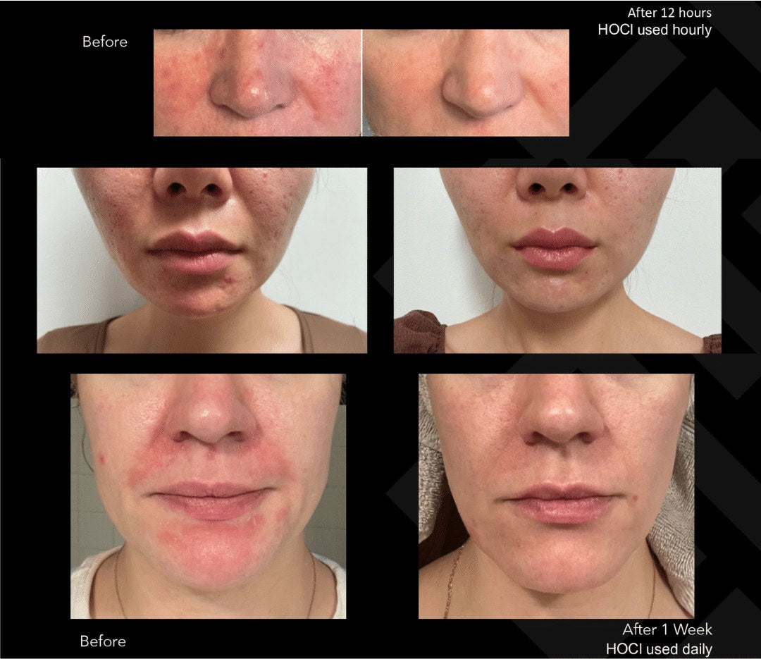 Hale Derma Hypochlorous Spray lifestyle image