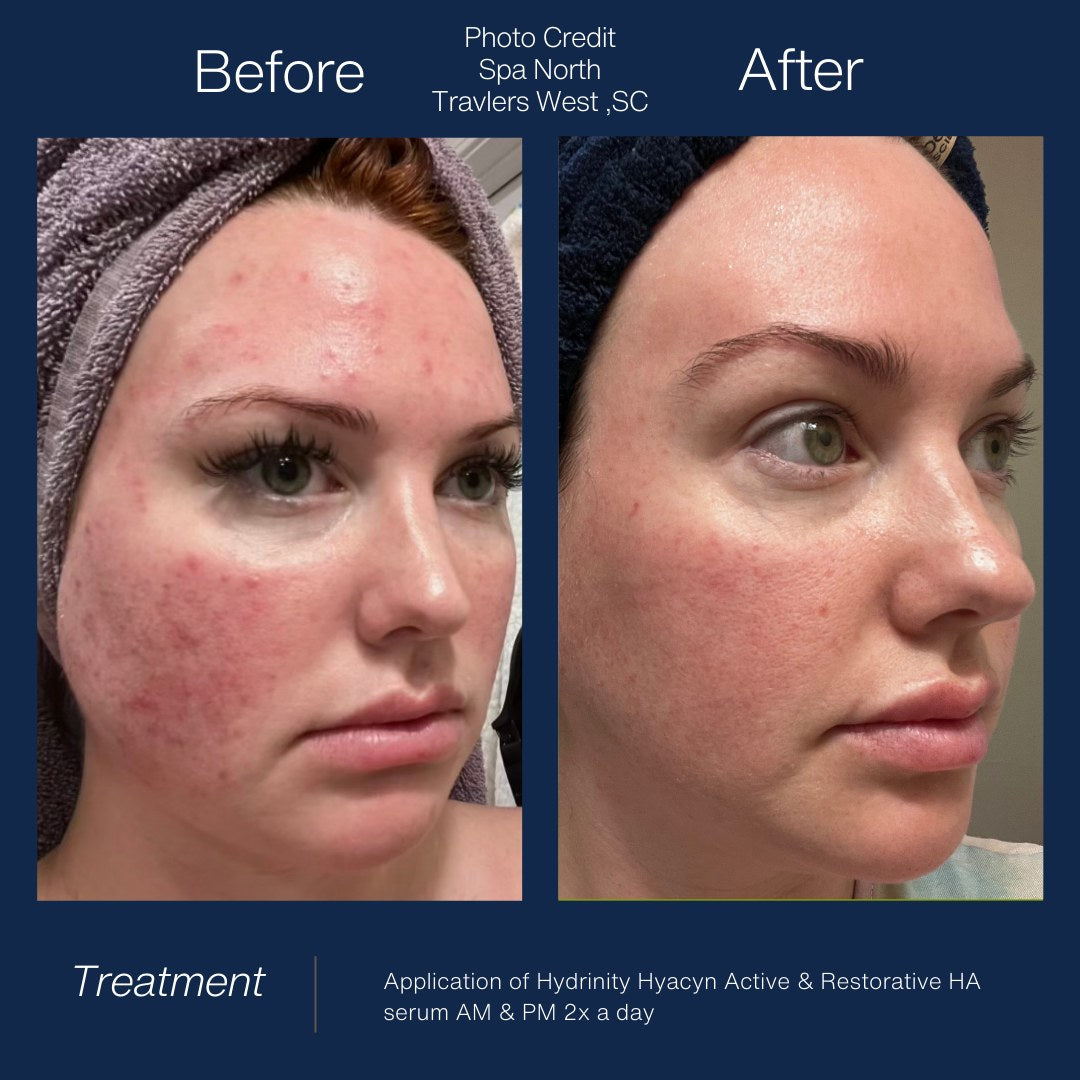 HYDRINITY Restorative HA Serum lifestyle image