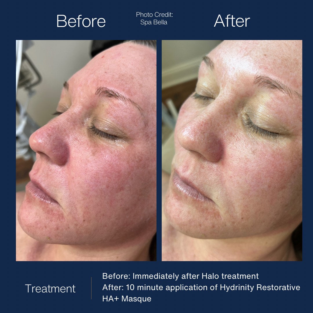 HYDRINITY Restorative HA+ Masque lifestyle image