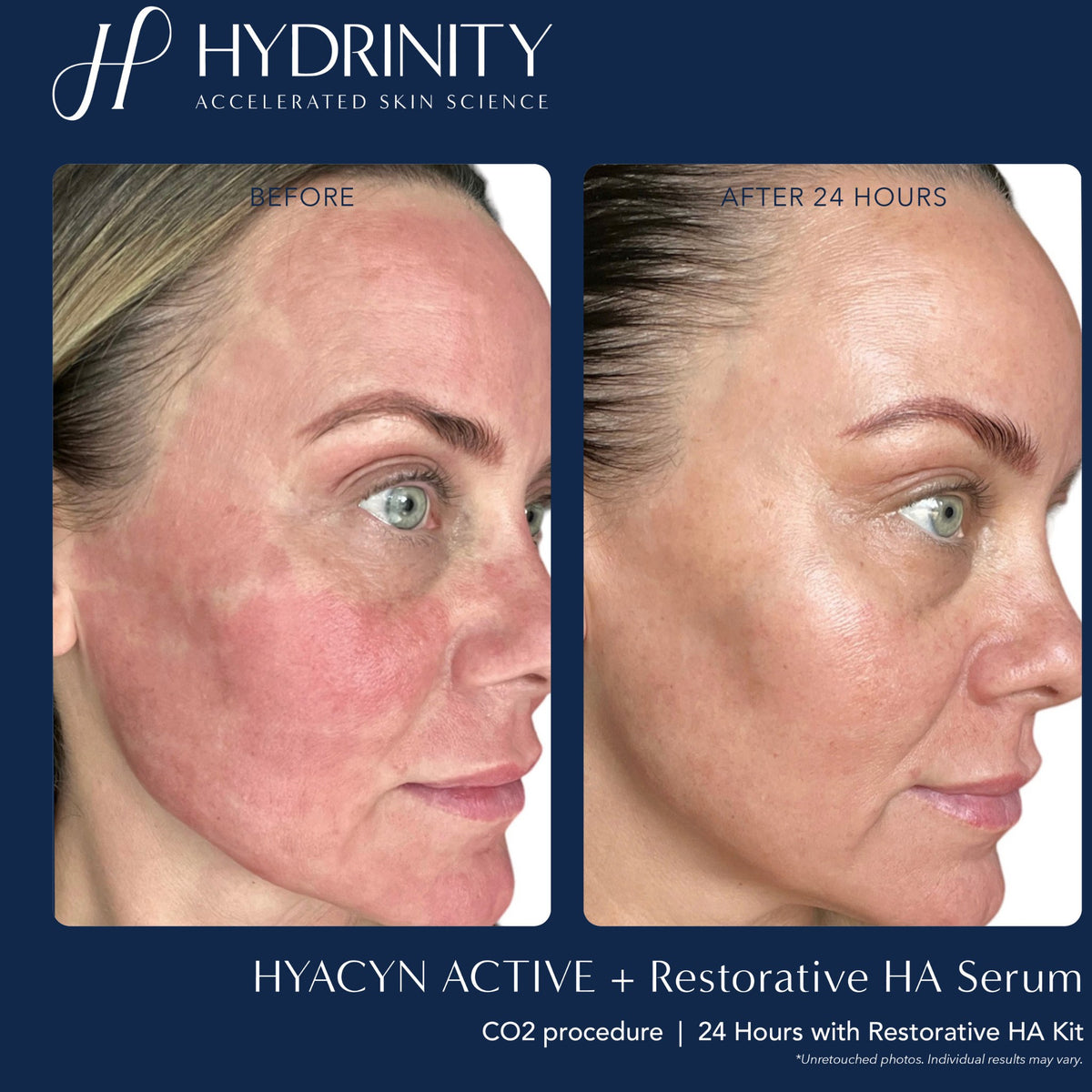 HYDRINITY Restorative Kit lifestyle image
