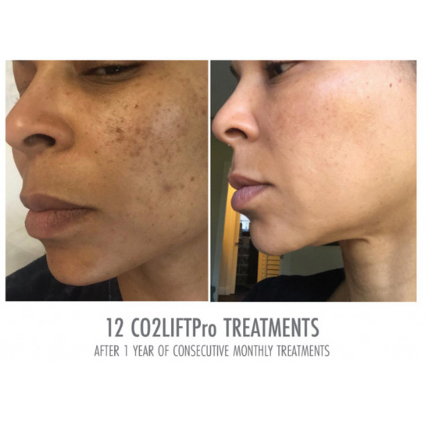 CO2Lift® PRO Mask