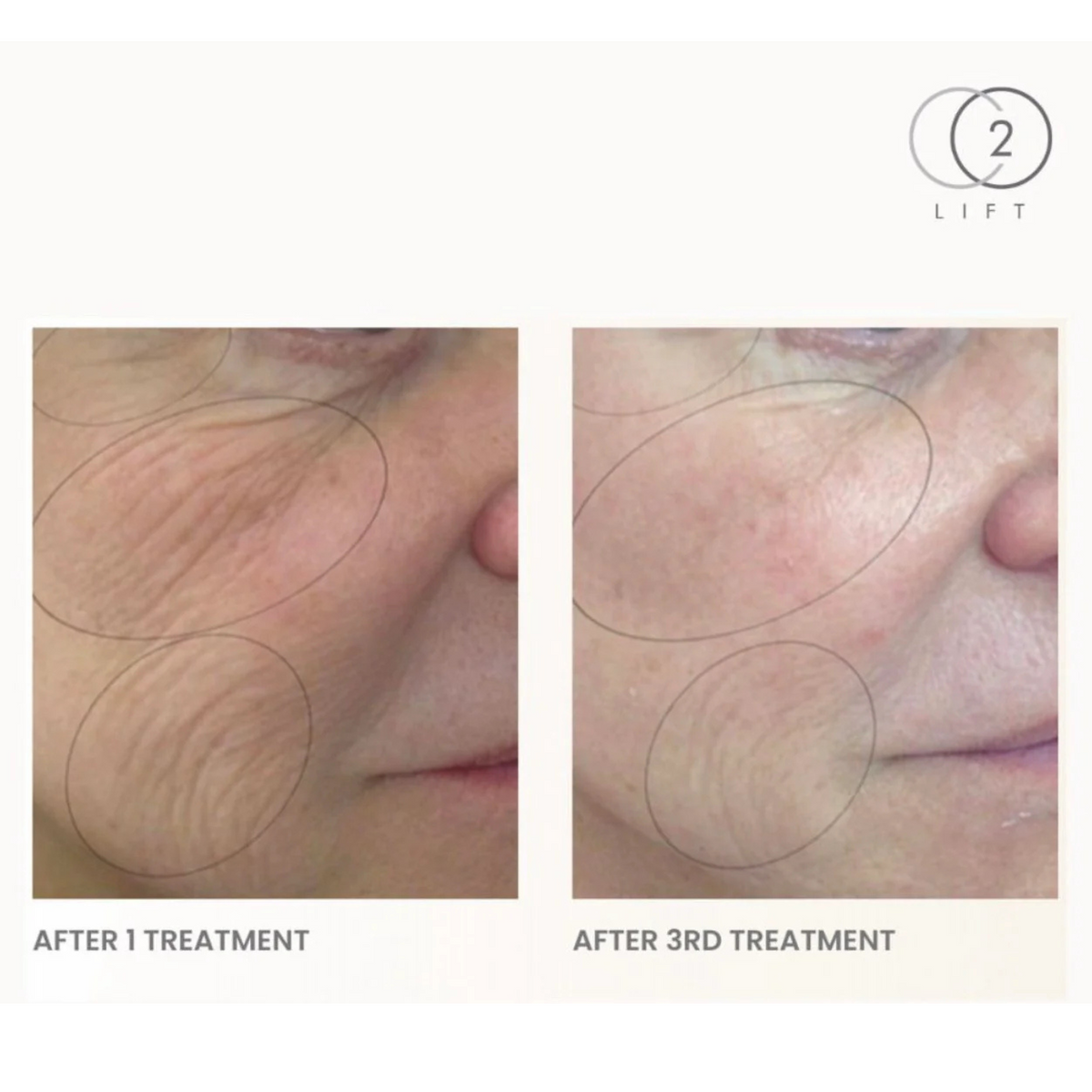 Lumisque CO2Lift PRO Mask gel mask, third view