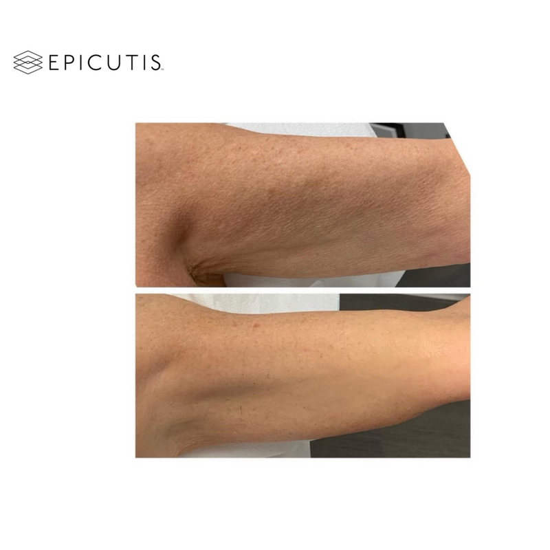 Epicutis Lipid Body Treatment