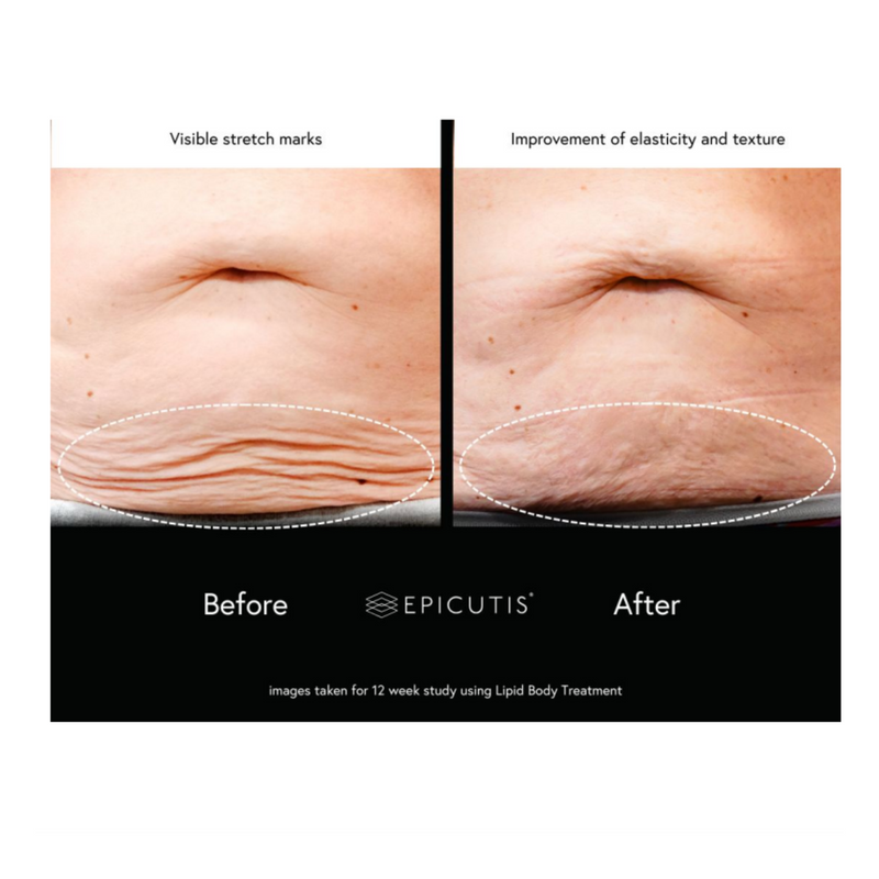 Epicutis Lipid Body Treatment
