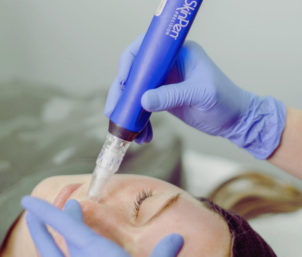 Model undergoing Morpheus8 treatment for facial rejuvenation at Studios Vis a Vis Toronto