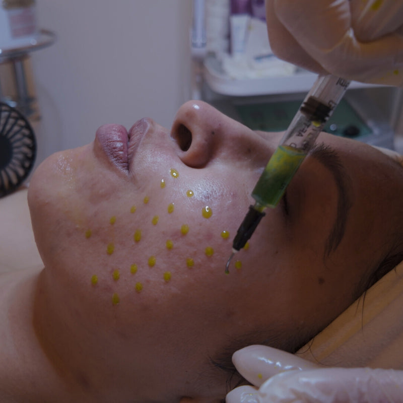 SkinPen® Microneedling + Booster + LED Light Therapy Series