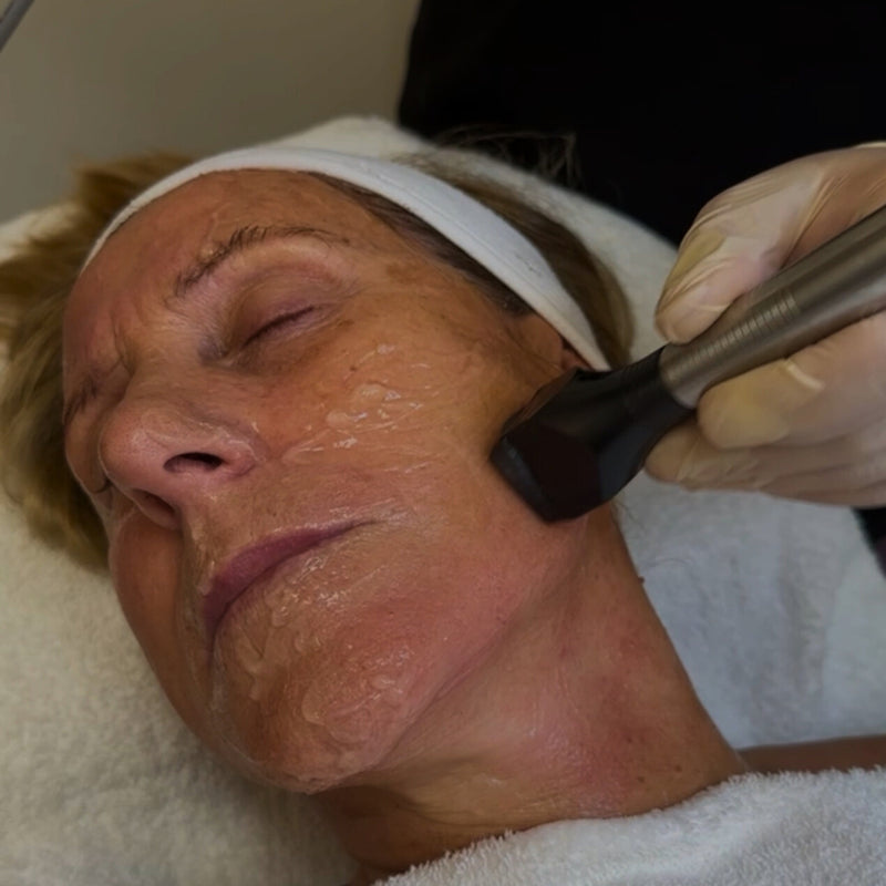 RF Skin Tightening Series