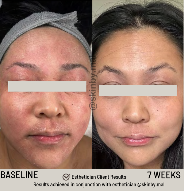 SIV Microbiome Balancing Serum