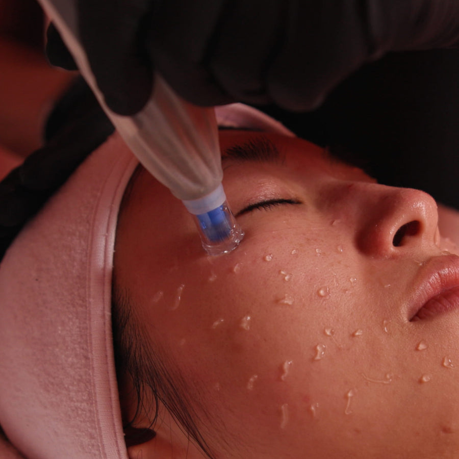 Microneedling