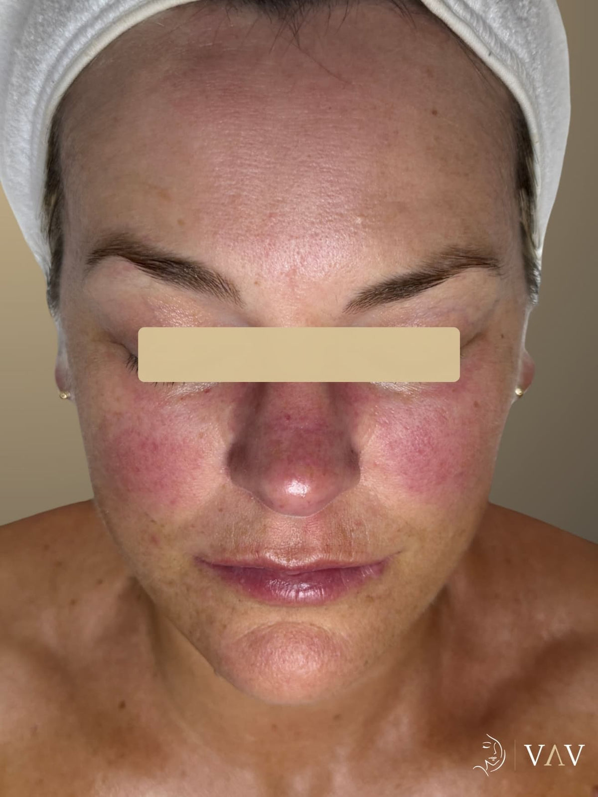 Before treatment, facial
