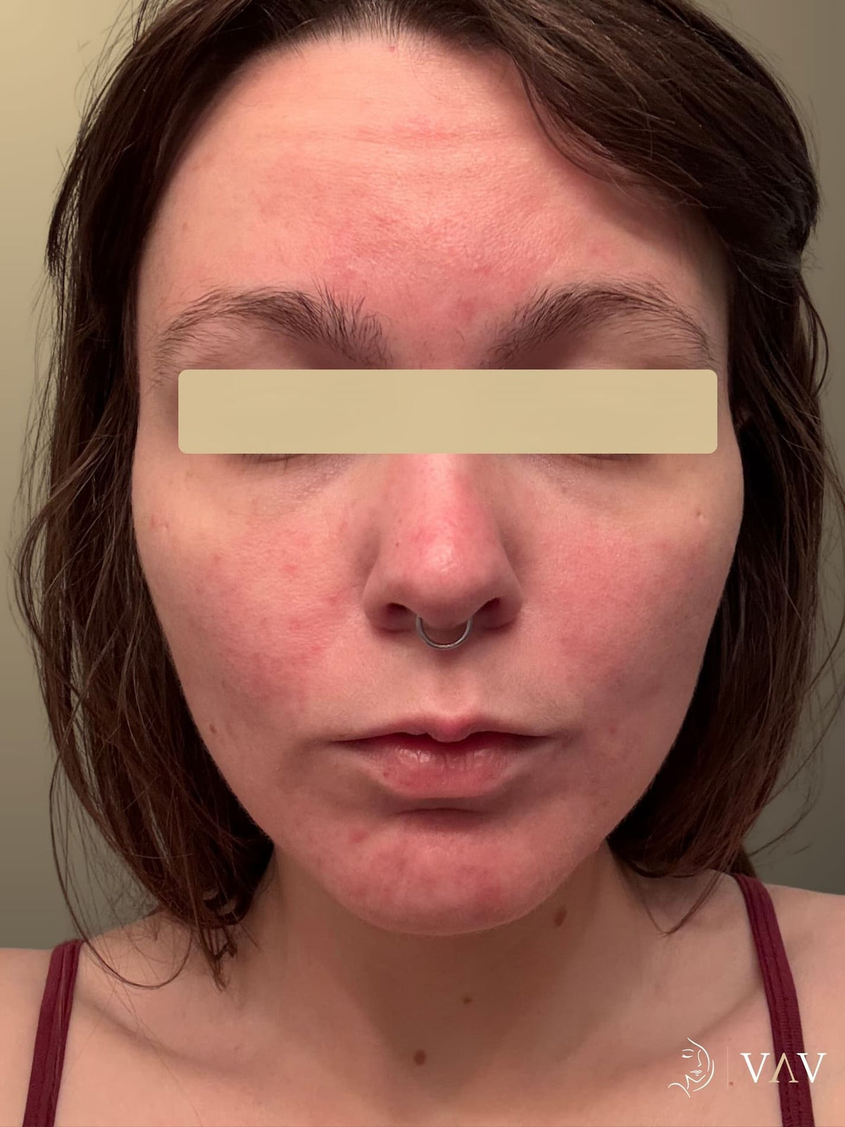 After treatment, acne treatment, front view