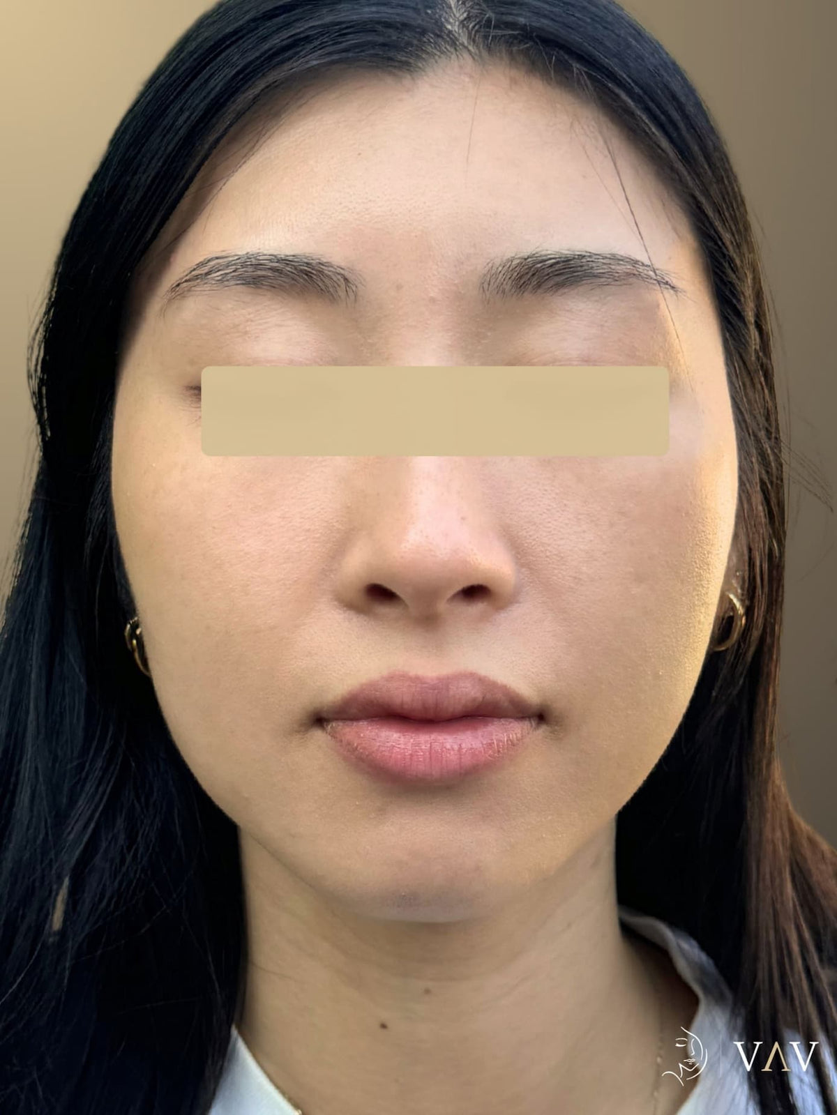 After treatment, Lumecca IPL