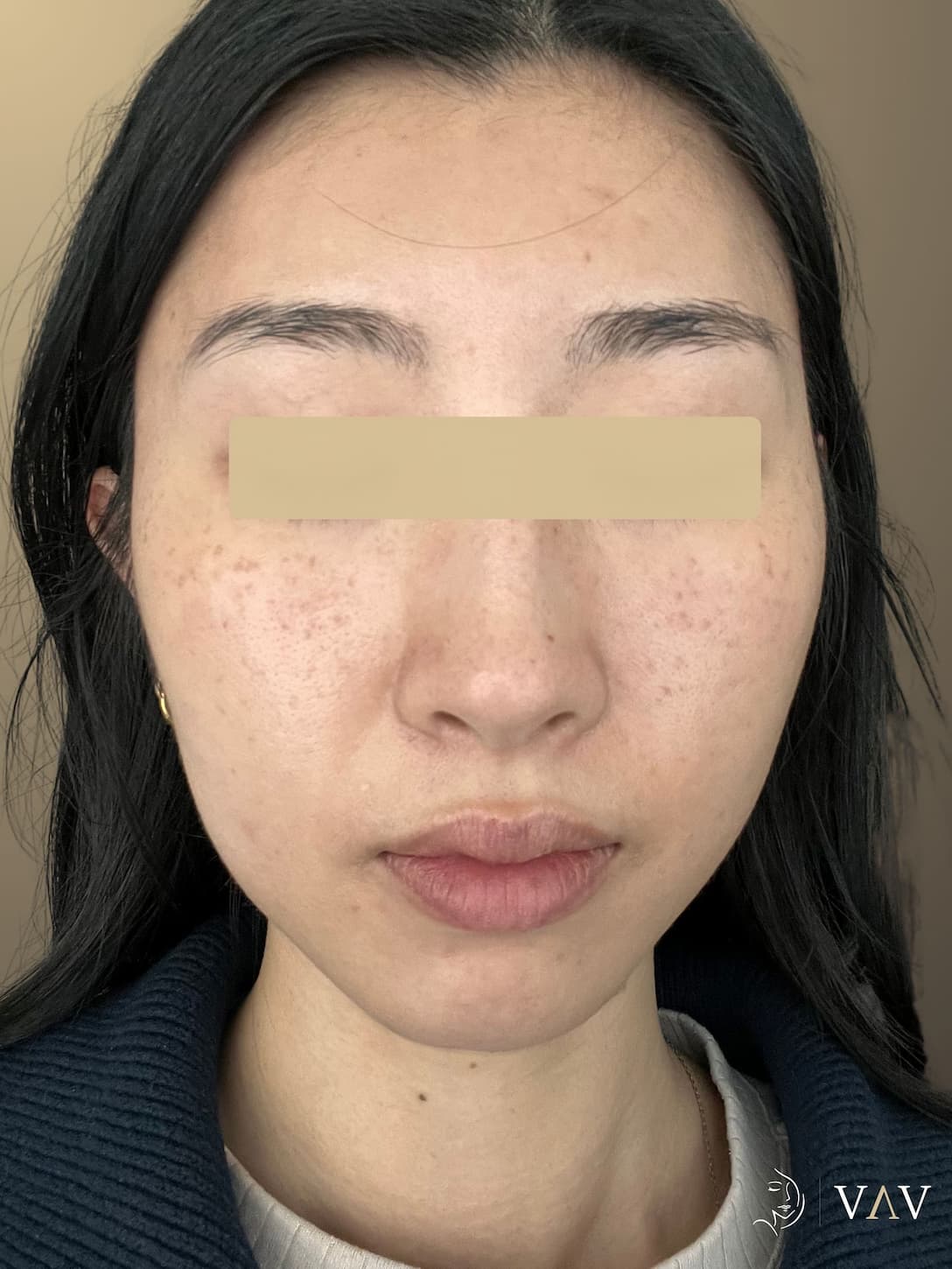 Before treatment, Lumecca IPL