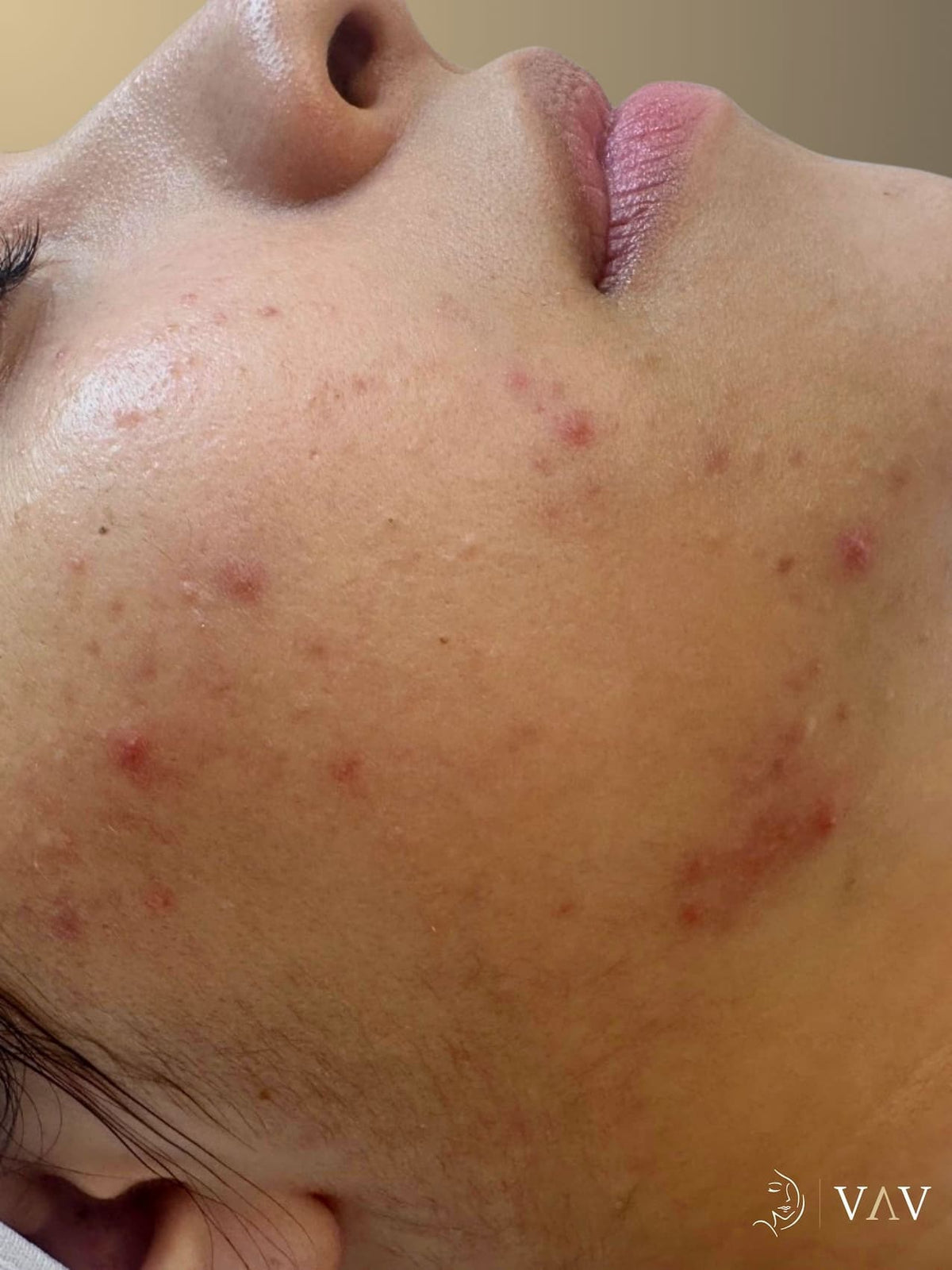 Before treatment, microneedling