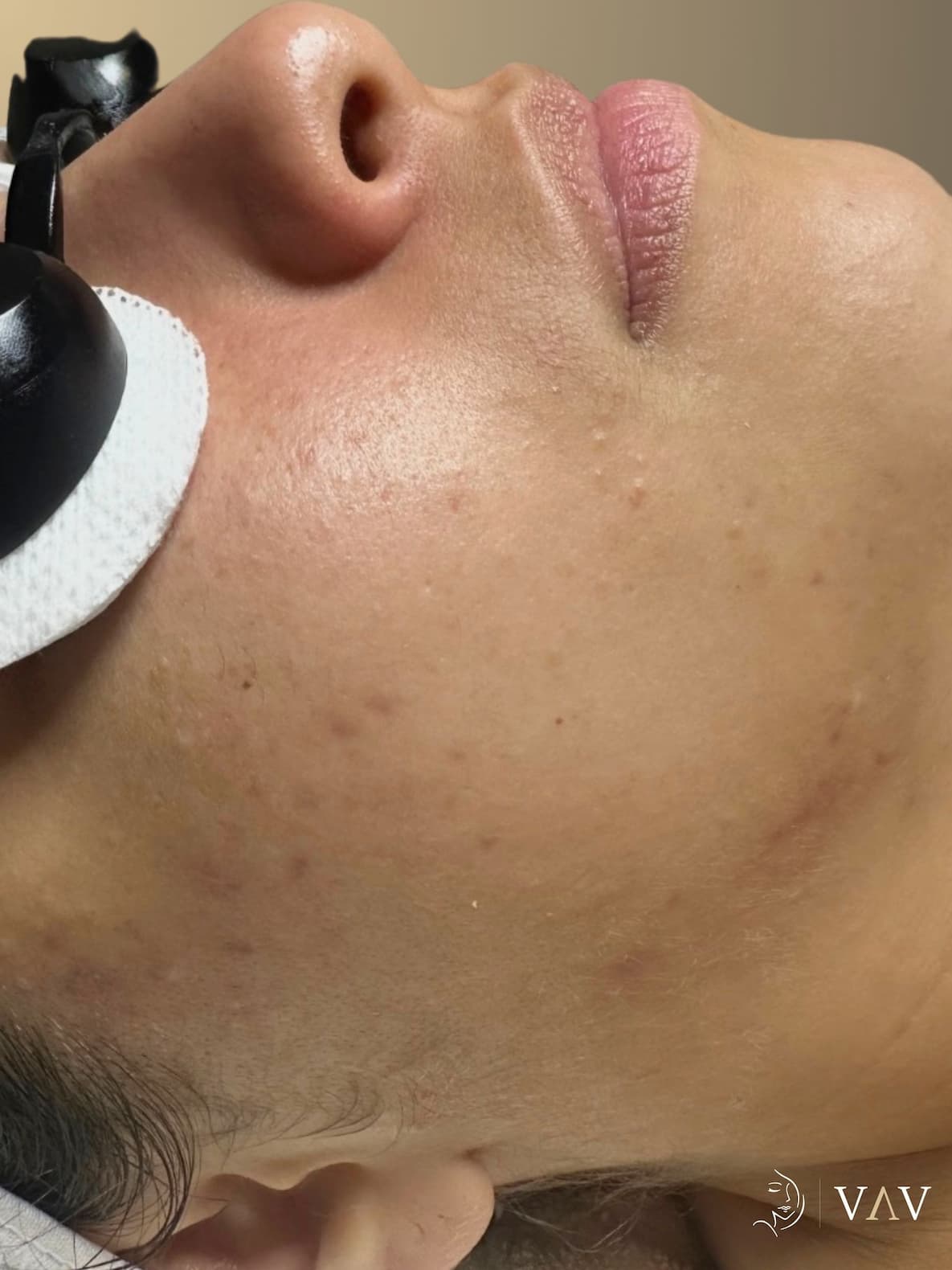 After treatment, microneedling