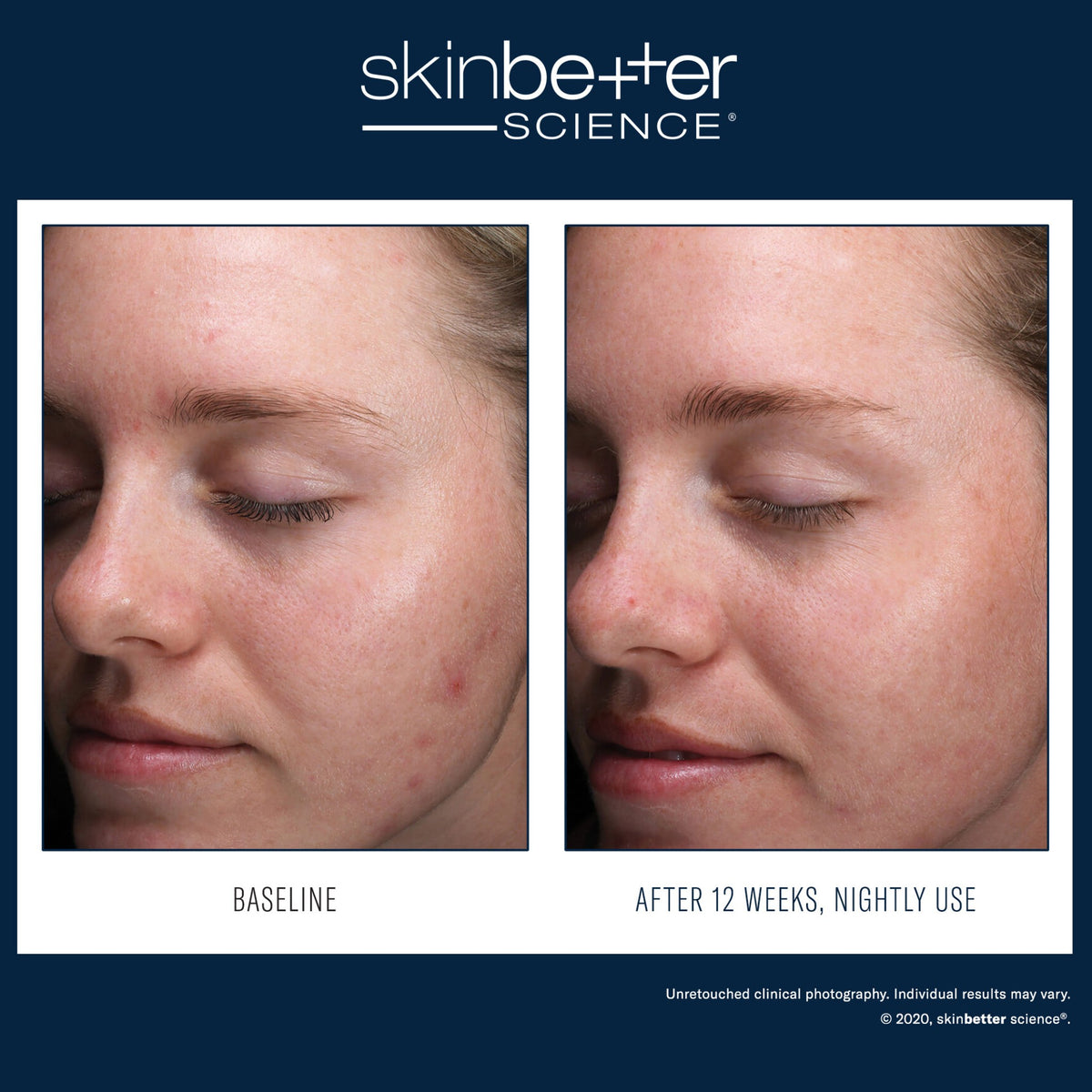 SkinBetter Science AlphaRet Clearing Serum lifestyle image