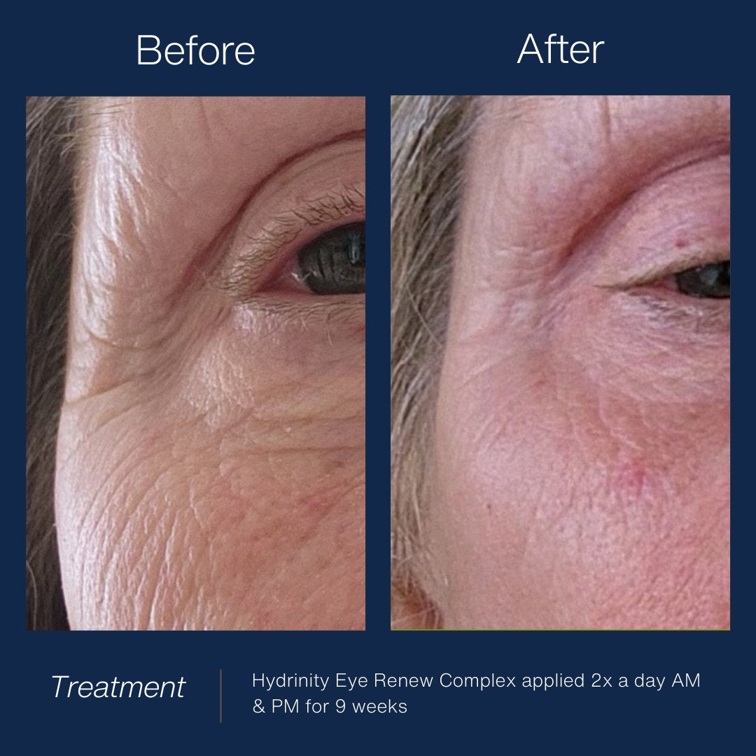 HYDRINITY Eye Renew Complex lifestyle image