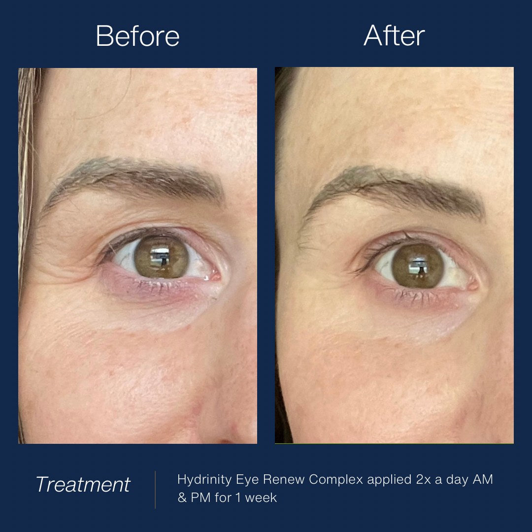 HYDRINITY Eye Renew Complex lifestyle image