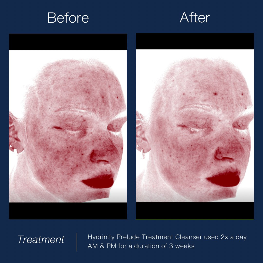 HYDRINITY Prelude Facial Treatment Cleanser lifestyle image