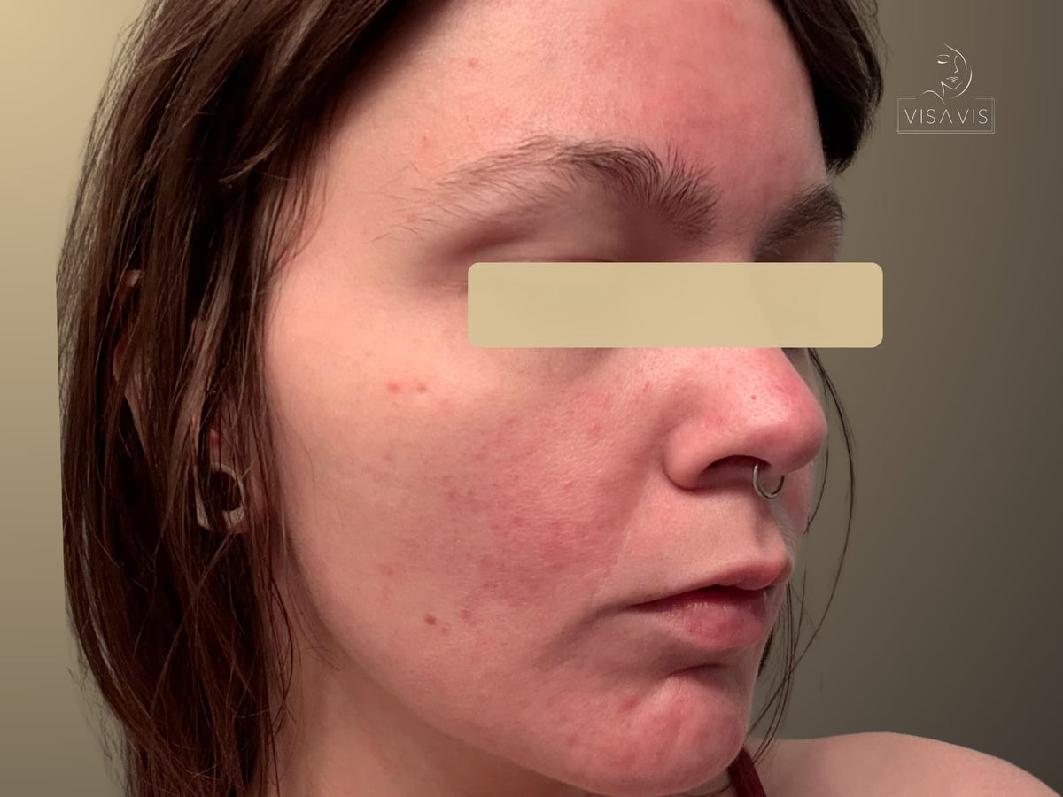 After treatment
