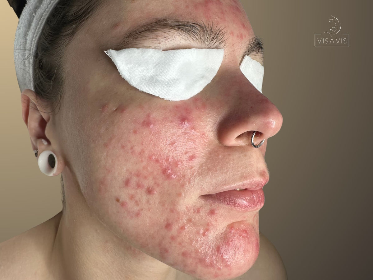 Before treatment