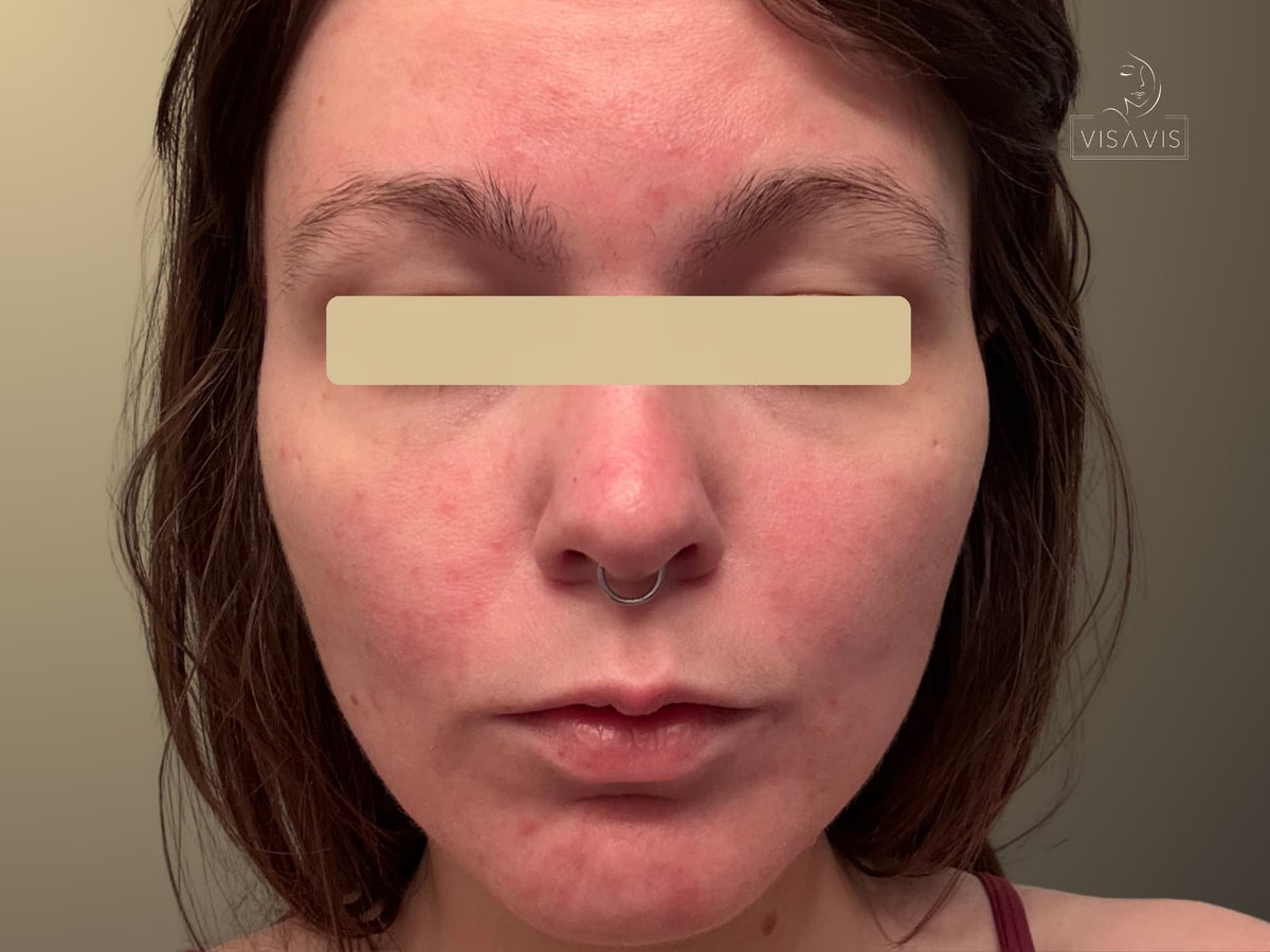 After treatment