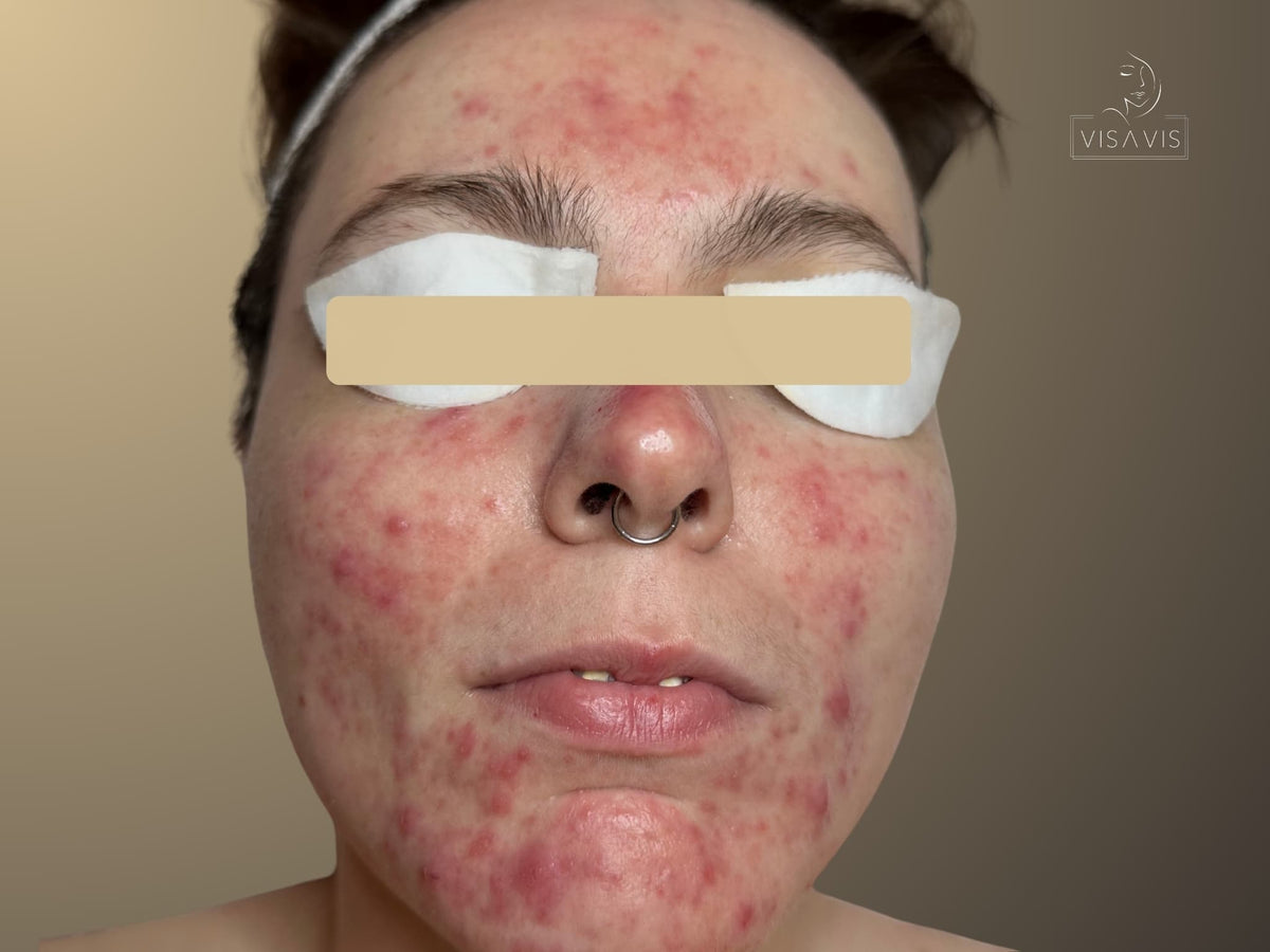 Before treatment