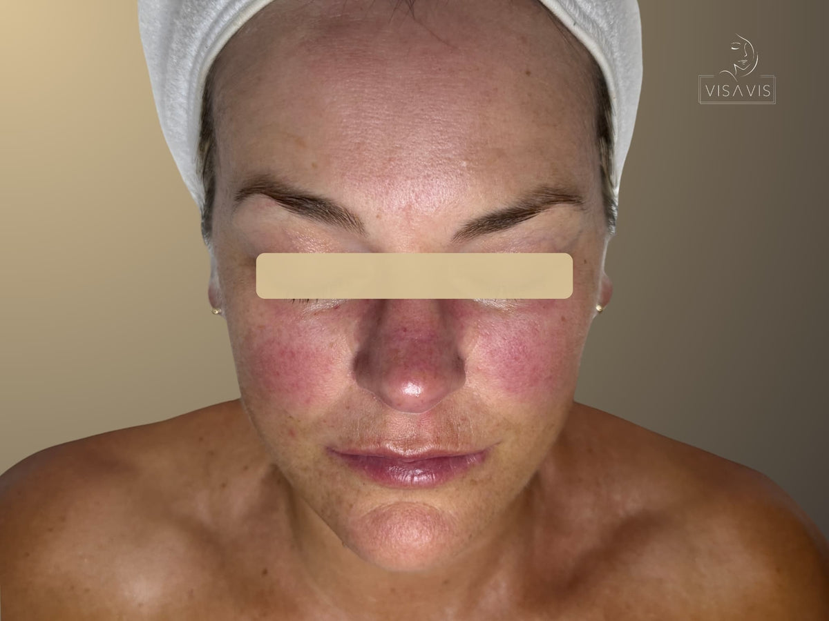 Before treatment