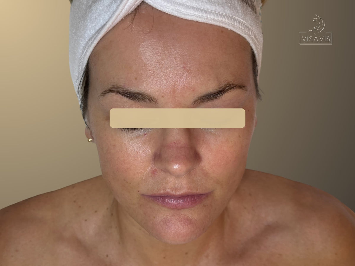 After treatment