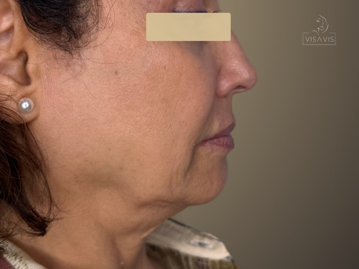 Before treatment