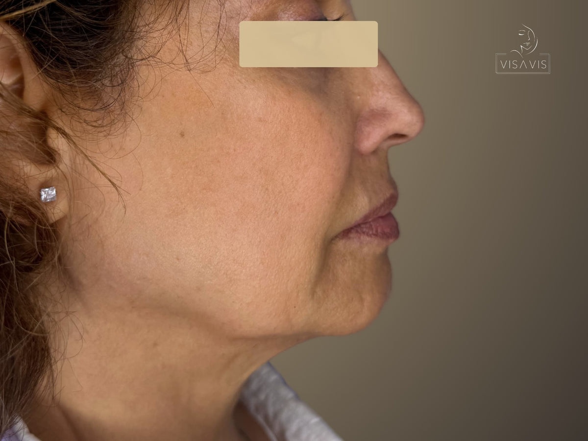 After treatment