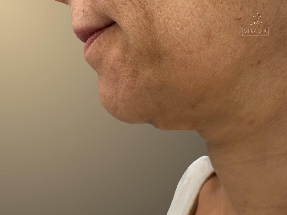 Before treatment