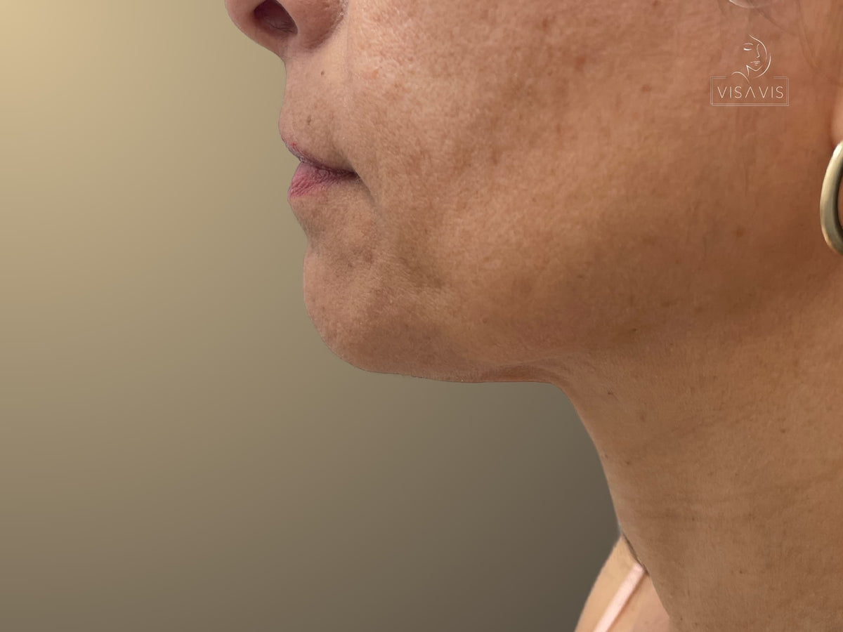 After treatment