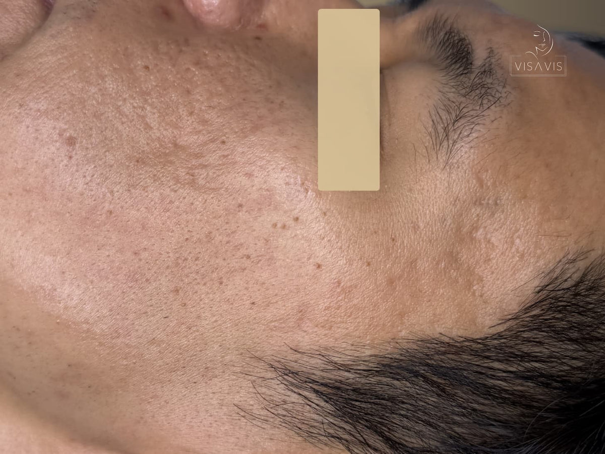 After treatment