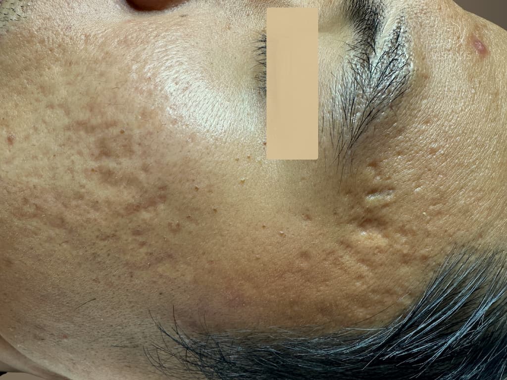 Before treatment
