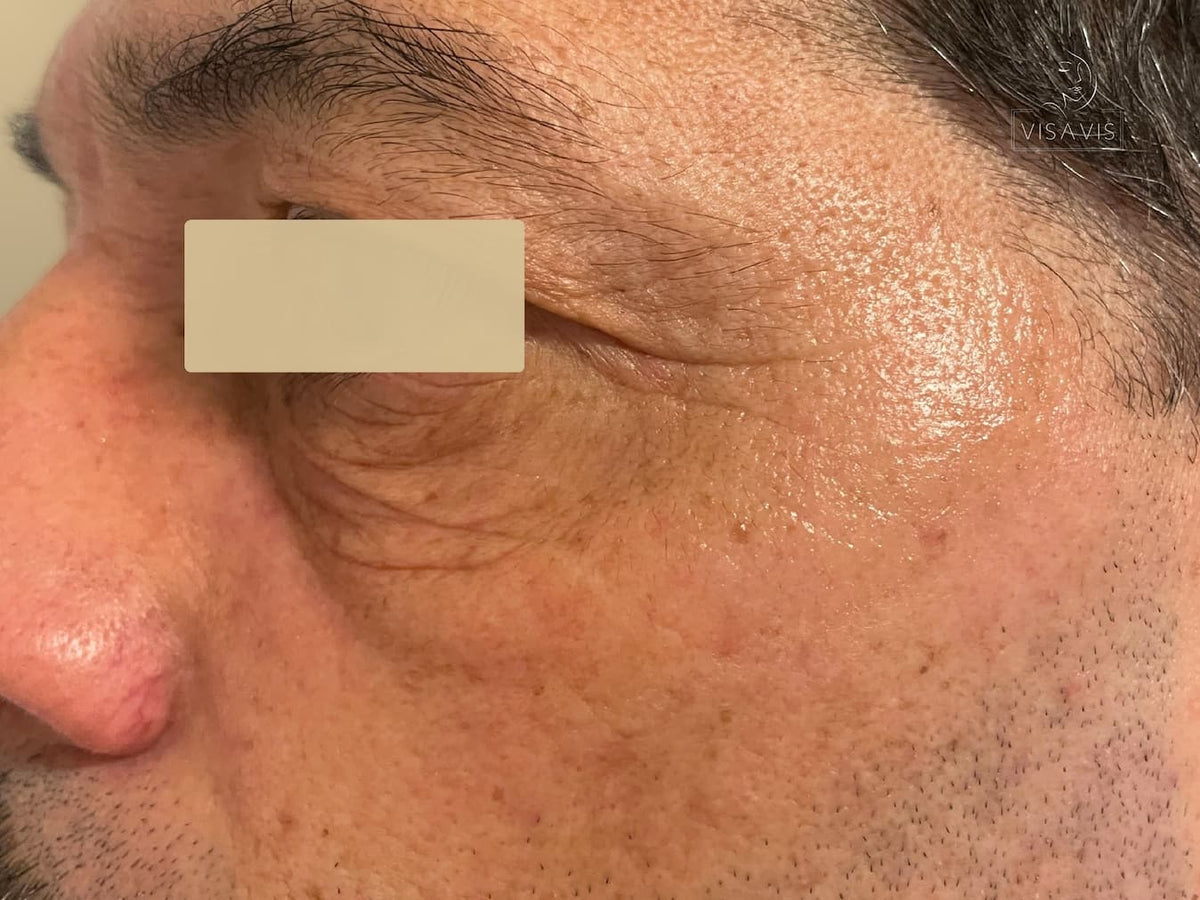 After treatment