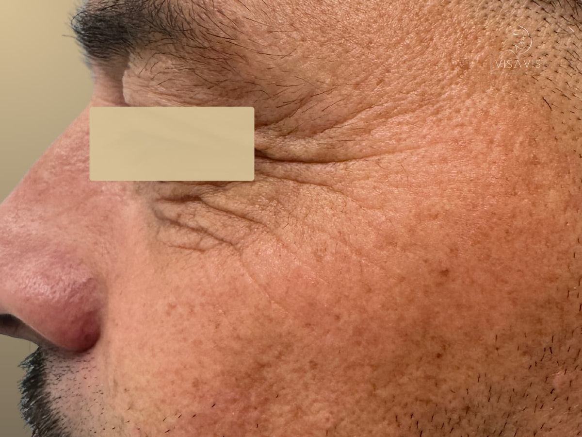 Before treatment